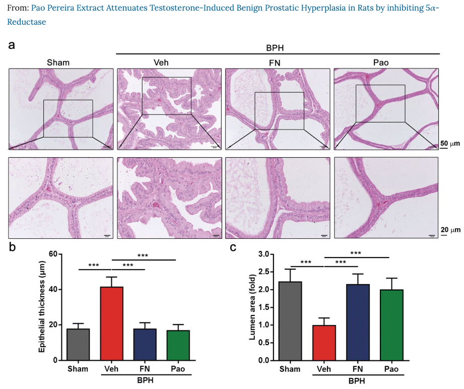 BPH Treatment Pao Pereria Figure 2