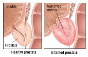 inflamated prostate