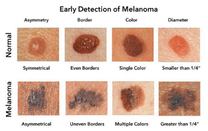 melanoma